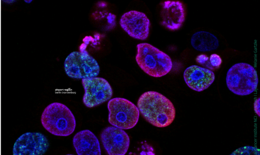 Image shows cancer cells under a microscope.