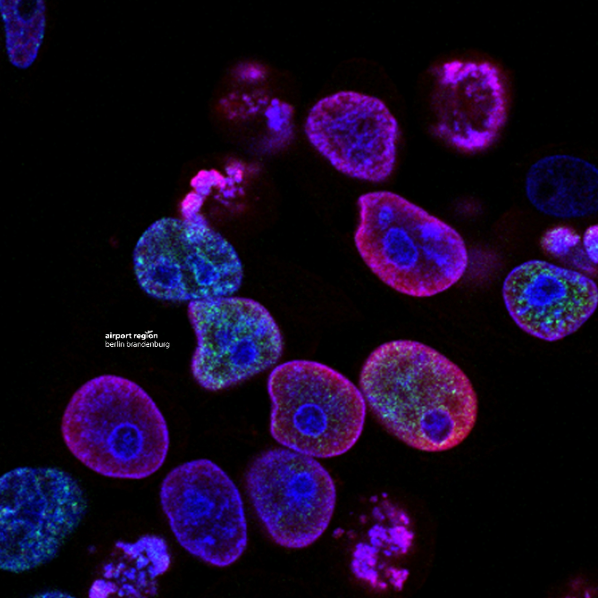 Image shows cancer cells under a microscope.