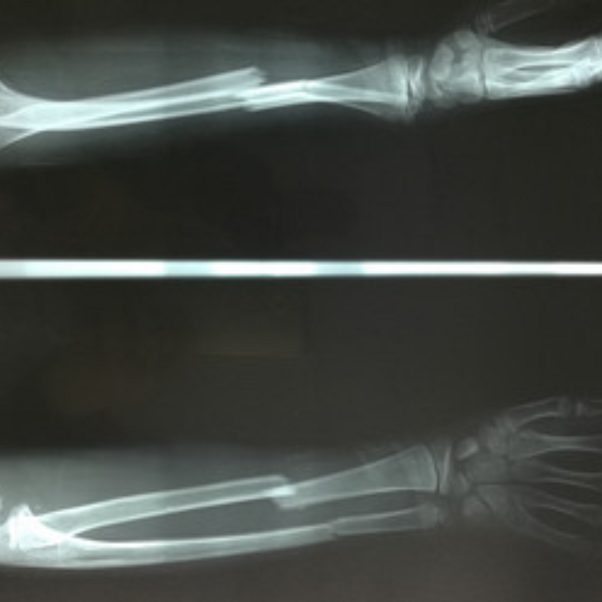 Image shows an X-ray of a bruised arm