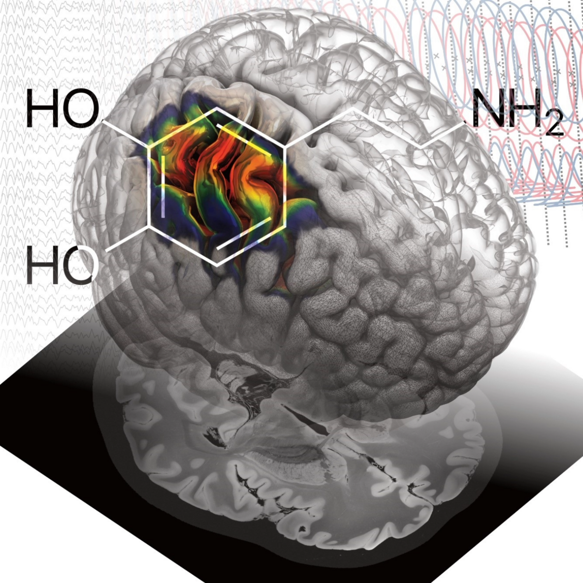 Machine learning deciphers brain signals from the sensorimotor cortex and shows the therapeutic effects of dopamine in Parkinson's disease.