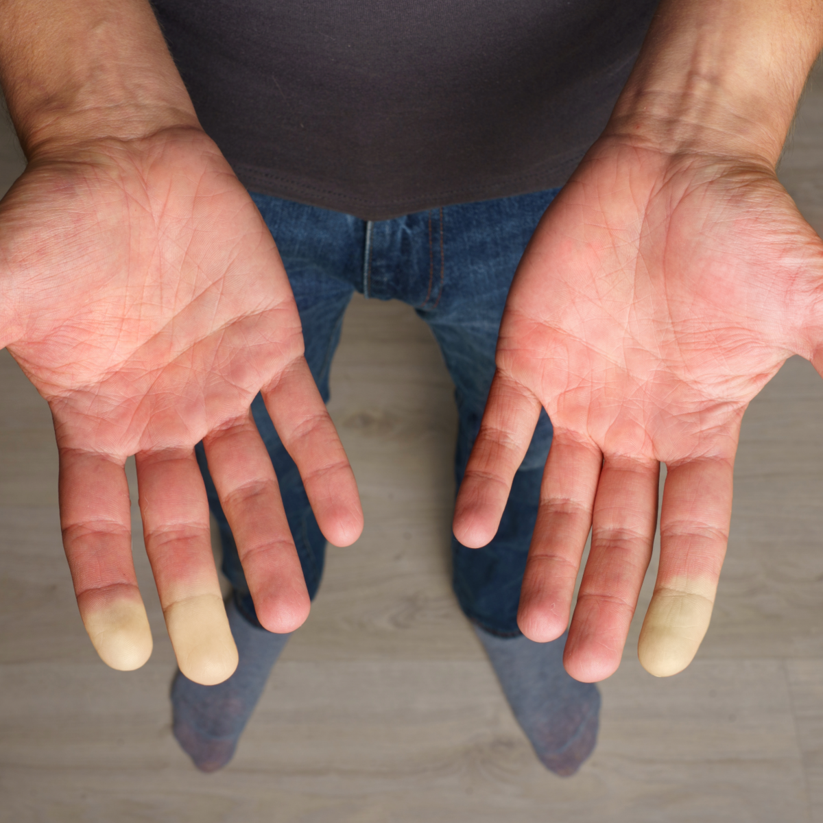 Picture shows the insides of two male hands. 3 out of 10 fingers have white fingertips because the man suffers from raynaud's white finger disease. Researchers have now investigated its causes. This is what the text is about.